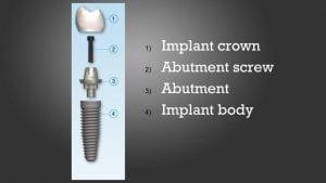 implant-tooth-construction-lynchburg