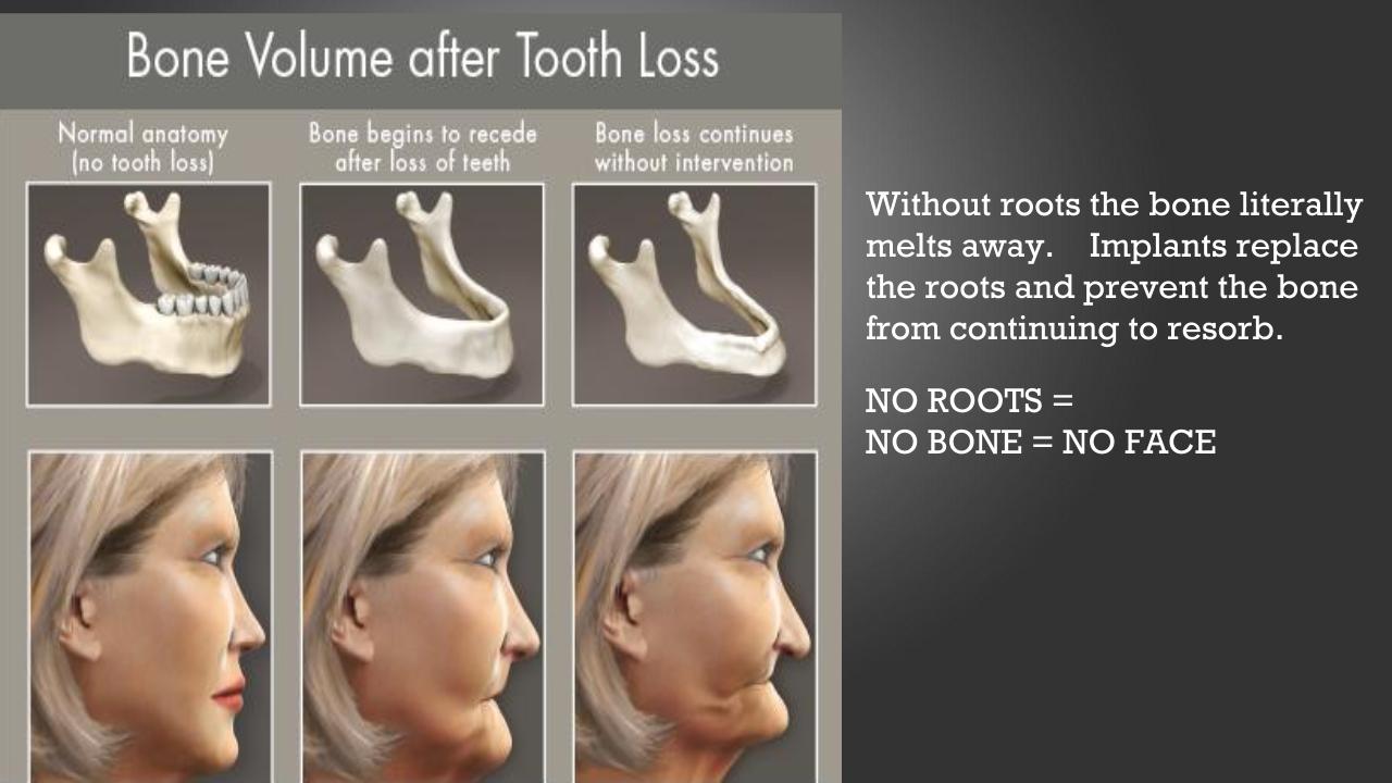 image shows a comparison of how tooth loss affects bone loss which affects how faces start to appear sunken