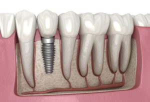 Dental Health Implant Illustration